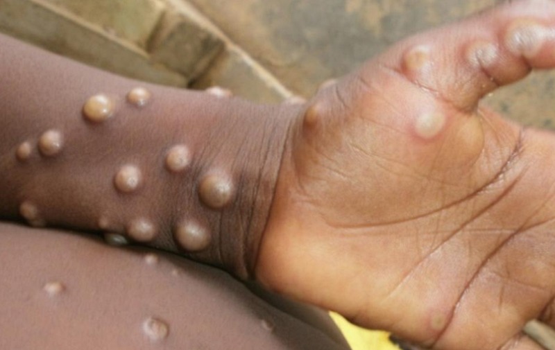 Duas mulheres são suspeitas de ter ‘varíola dos macacos’ em Manaus